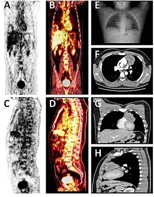 Primary mediastinal seminoma with azoospermia: case report and review of the literature